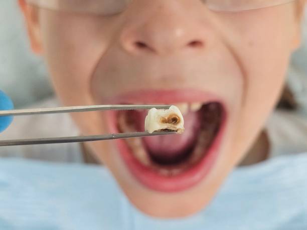 Best Emergency Treatment for Dental Infections or Abscesses in Raubsville, PA